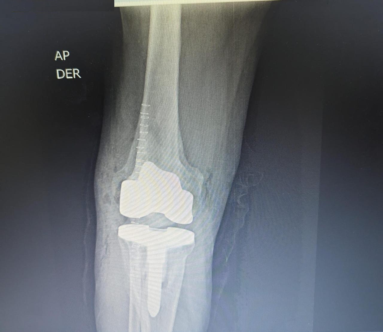 Radiografía Postoperatoria Rodilla